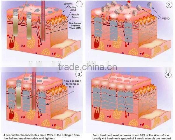 2015 new!!! professional Rhytidectomy Fraction vaginal acne removal machine co2 laser articulated arm
