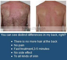 Fast hair removal 808nm diode laser 600w 150mj