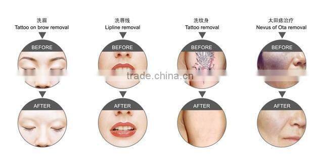 Multifunctional 2015 newest IPL laser hair removal machine