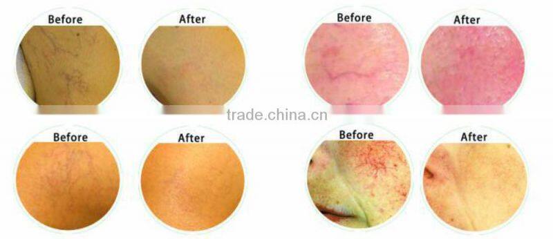 vascular removal laser 980 laser diode 40w diode laser 980nm machine for medical use