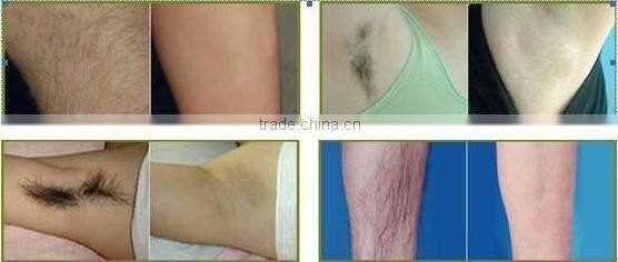 CE approved portable effective 808nm diode Laser Hair Removal machine for permanent depilation