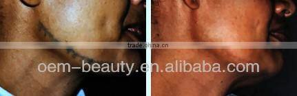 Real low price q switched nd yag laser tattoo removal machine