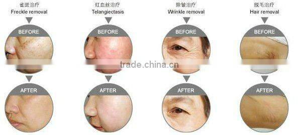 OPT System IPL+RF Freckles Treatment Clinic Machine