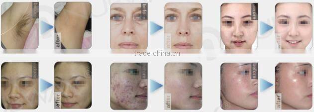 hair removal / Portable ipl laser hair removal machine / ipl home
