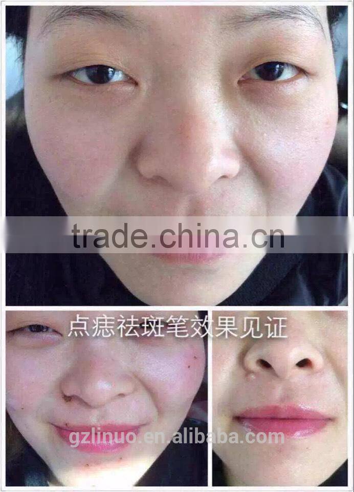 Beauty and health mole removal machine , nevus removal machine