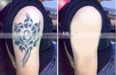 2016 HOT SALSE! new products q switch nd yag laser for tattoo removal system, nd yag laser machine with CE and GOST-P