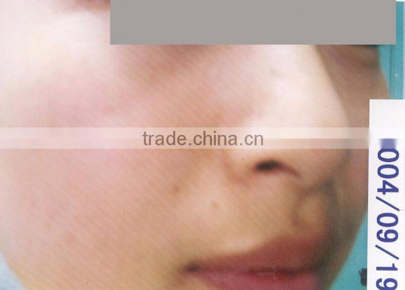 acne removal beauty device elight beauty ipl laser machine price