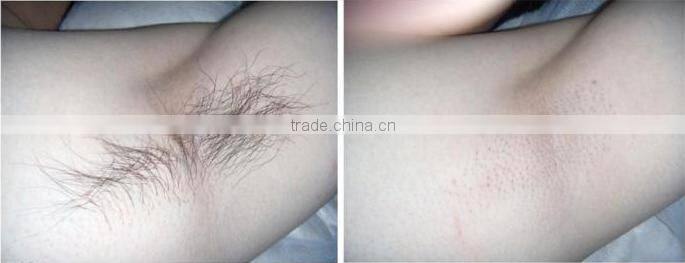 Advanced cooling system painless permanent laser shr IPL hair removal machine