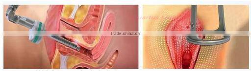 High-tech fractional co2 laser/rf tube co2/fractional laser/ co2 fractional laser