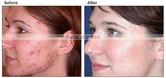 Renew The Elasticity Of Skin Photofacial IPL Equipment---A005