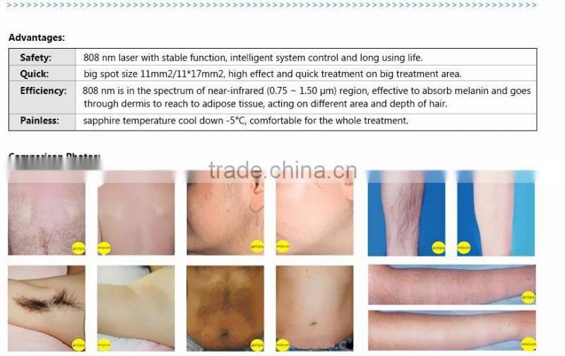 High quality professional laser hair removal machine 808nm diode