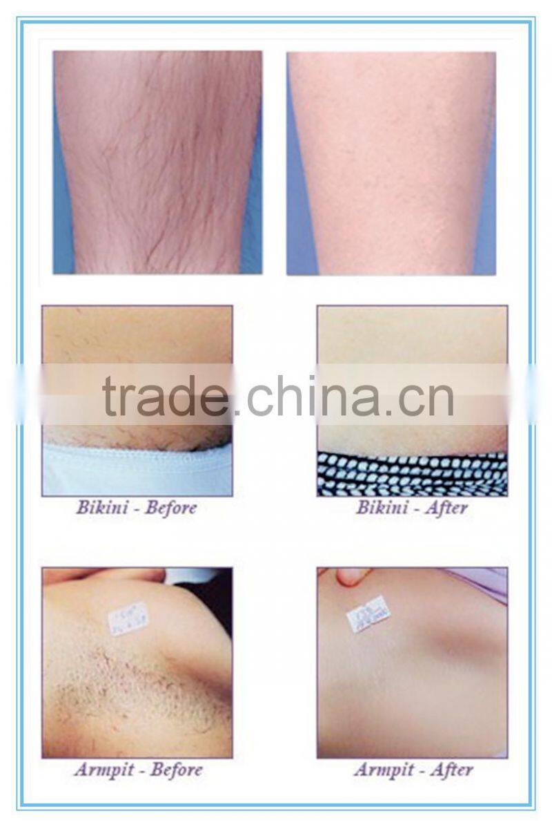 distributor wanted europe skin care equipment ipl