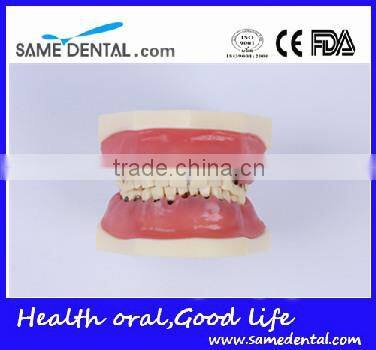 Dental Severe Periodontal Disease Model School Teaching