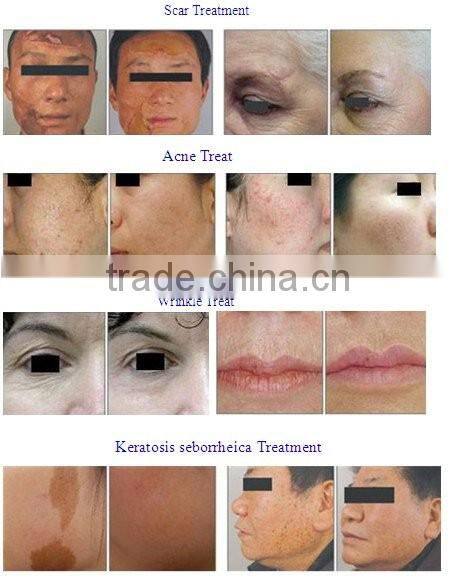 2016 Co2 Laser / Fractional Co2 Laser machinel Co2 Fractional Laser for acne treatment and wrinkle removal