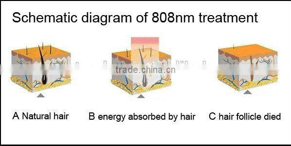 808nm diode laser epilator hair remover permanent hair removal