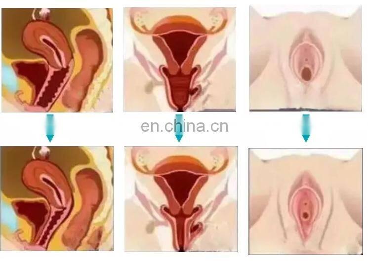 Portable female private parts nursing rf vaginal tightening rejuvenation beauty machine