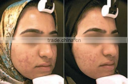 Permanent hair removal machine IP portable IPL for hair removal skin rejuvenation, acne removal