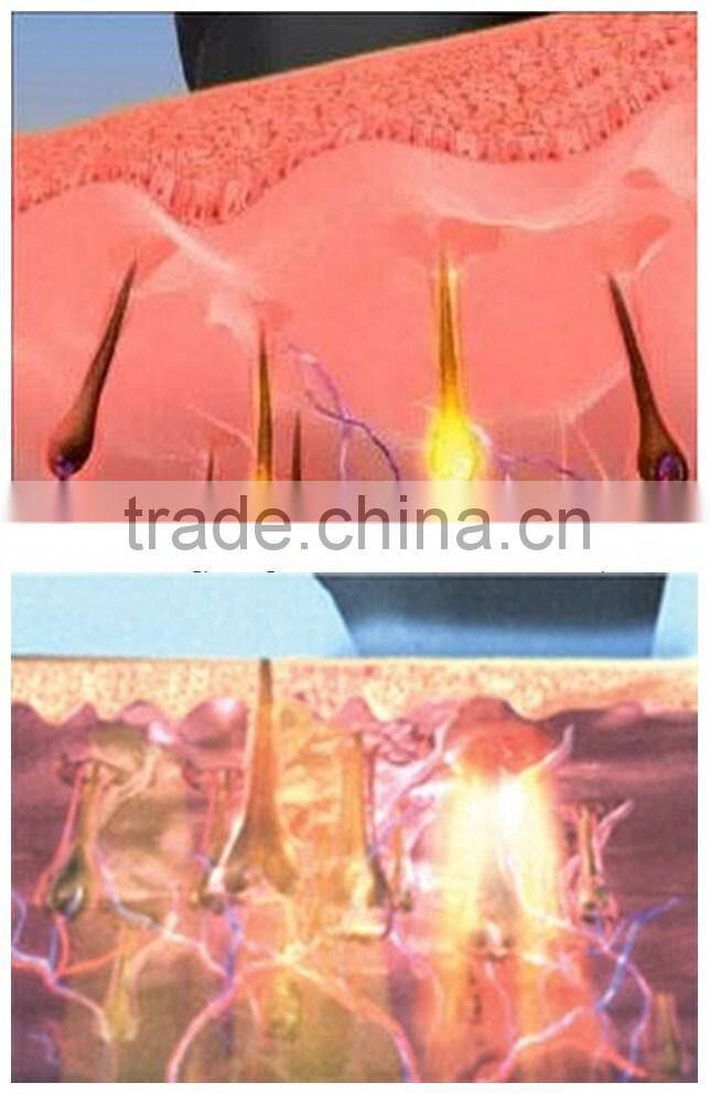 2014 New! Permanent hair removal lasermachines for sale