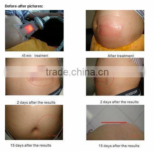 NEWS! Sales Promotion professtional 2 hand pieces Cryolipolysis cryo liposuction machine