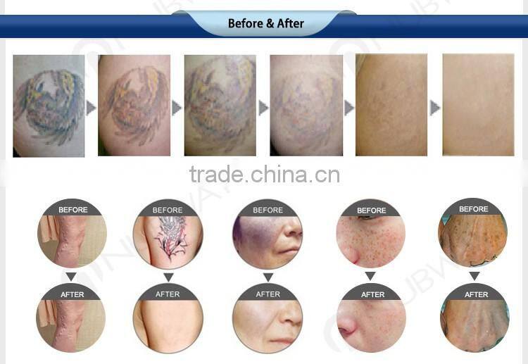 Gentle yag laser 1064nm q-switch nd yag laser tattoo machine