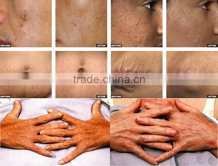 Factory direct sales CE FDA approved 7 hinged joint arm best co2 fractional laser peel machine