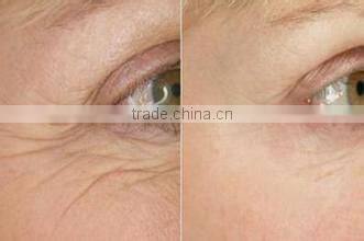 Best Matrix rf fractional with microneedle machine for wrinkle removal
