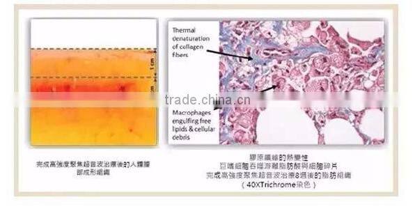 Newest technology liposonix for slimming machine