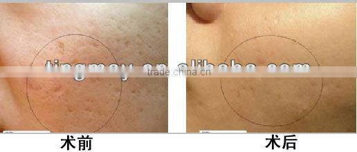 Skin Tighten Dema Roller Skin Care