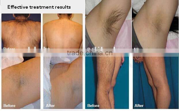 KLSi Diode Laser Hair Removal 808nm Laser Skin Rejuvenation (808)