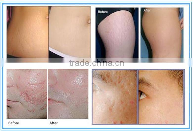 medical equipments co2 laser vaginal rejuvenation