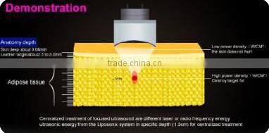 High intensity focused ultrasound body fat burning / liposunic / ultrasonic machine