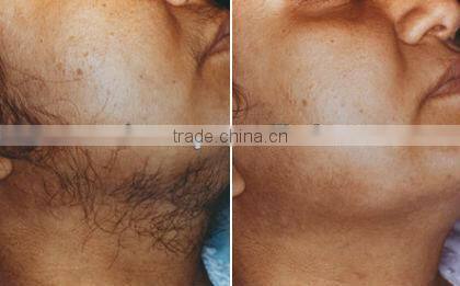 Medical machines--Cooling probe laser Hair removal/varices removal machine-P003 with protect glass/goggle