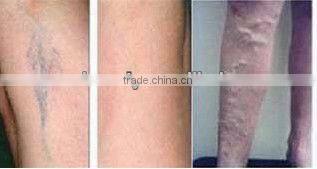1064nm long pulse laser hair removal machine spider vein removal anti redness P003