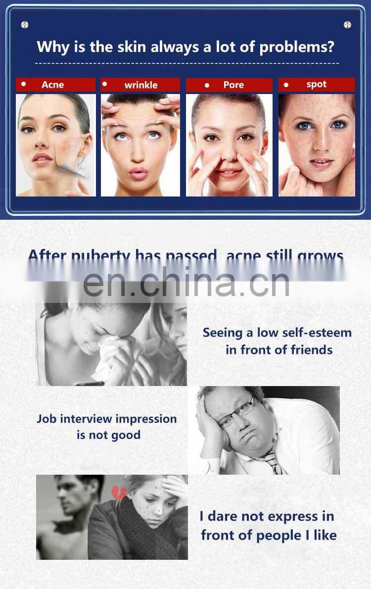 Hot selling best acne treatment acne scar removal blackhead removal beauty device