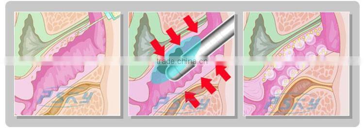 10000 shots woman painless vaginal rejuvenation HIFU machine for sale