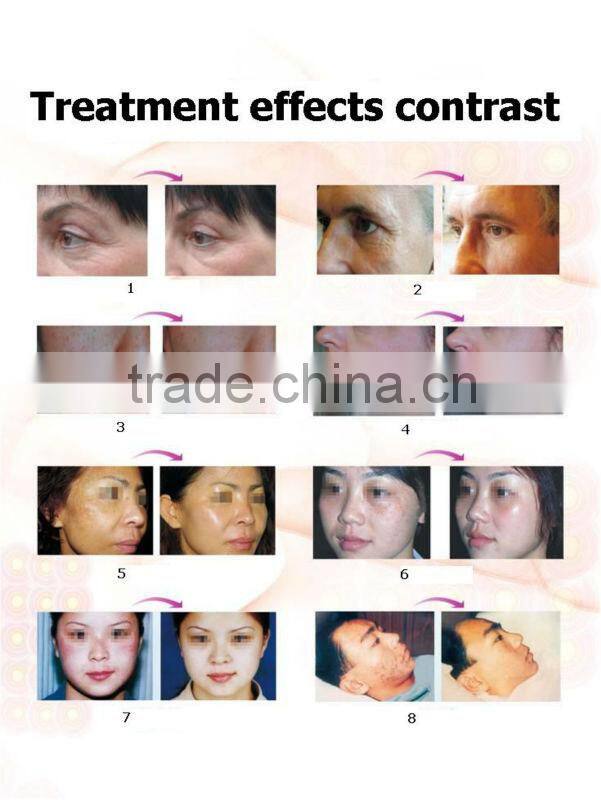 New Technology OPT Permanent E Light IPL RF Best Dark Spot Pigment & Acne Scar Removal Beauty Machine