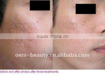 Microneedle derma roller 0.25 till 2.5mm L009