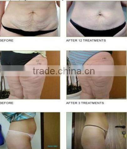 ultra 40khz cavitation beauty machine/portable ultrasonic cavitation machine