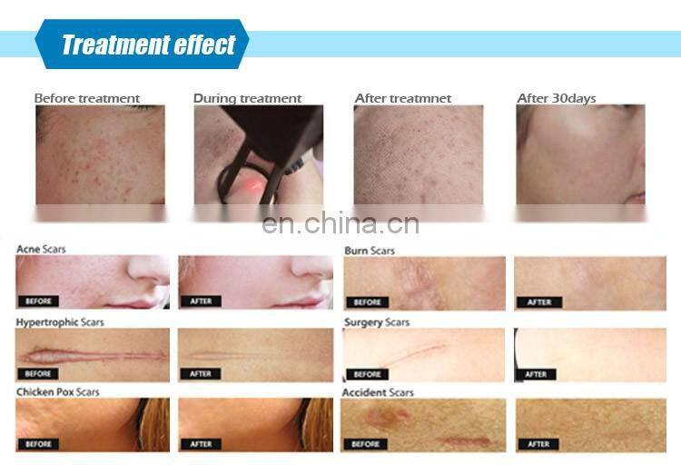 Fractional CO2 Laser Stretch Marks Removal Beauty Machine