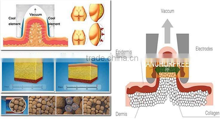 Best selling weight loss fat reduction cryo vacuum body slimming system