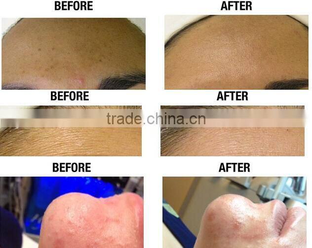 OEM ODM best multifunctional Portable jet peel oxygen facial machine for skin rejuvenation