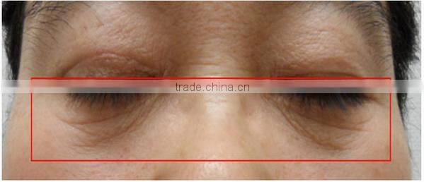 Hot!!! New products,portable home hifu anti-wrinkle machine /hifu machine home