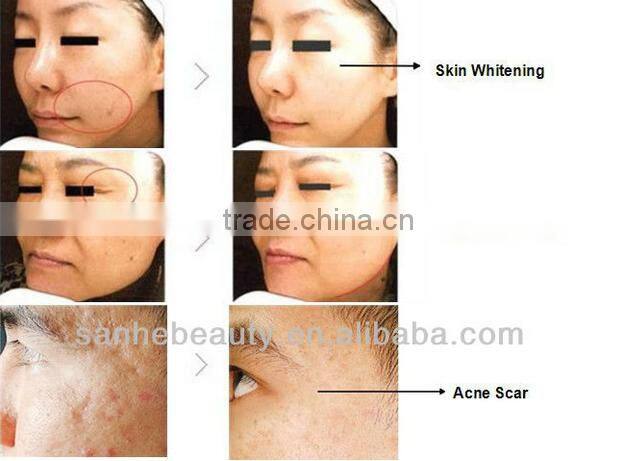 2016 best Micro Needle RF and Fractional RF system/ spider vein removal machine