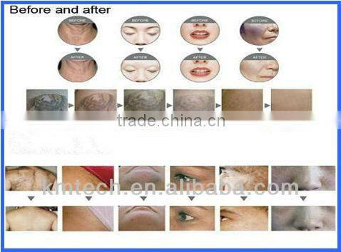 Factory outlets!! 3 in 1 elight ipl nd yag laser with CE ISO TUV SGS