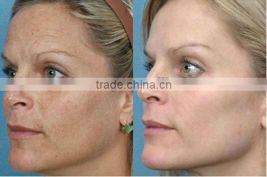 skin rejuvenation elight/ at home skin tightening machine C005