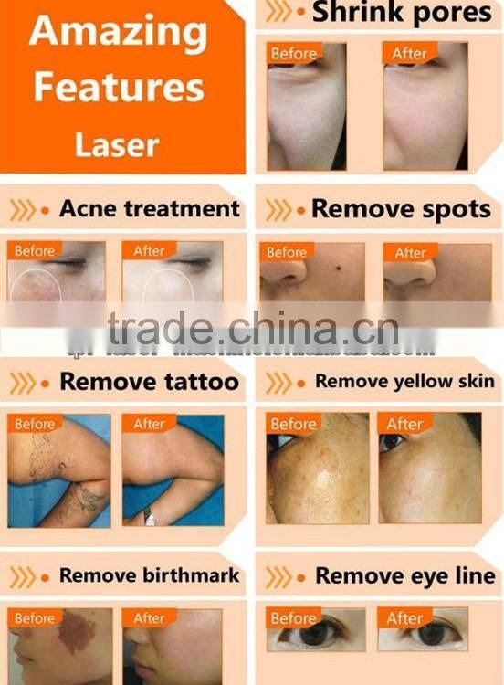 Multifunctional Nd-Yag Laser Tattoo Removal Machine Price for Black Doll Treatment