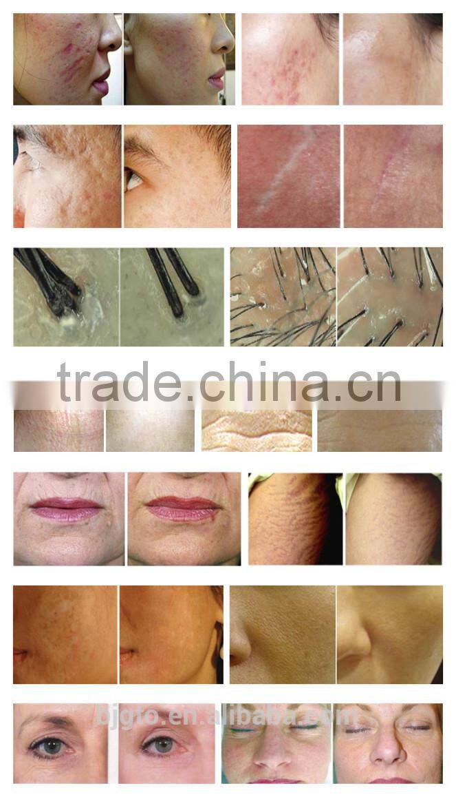 GTO Hot sale 540 count derma roller with CE approval and travel case for price is low