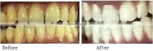 2016 the newest dental gum protection gel for teeth whitening kit