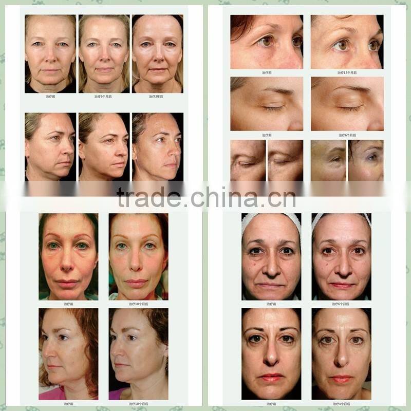 AYJ-T29B ayplus face slimming machine