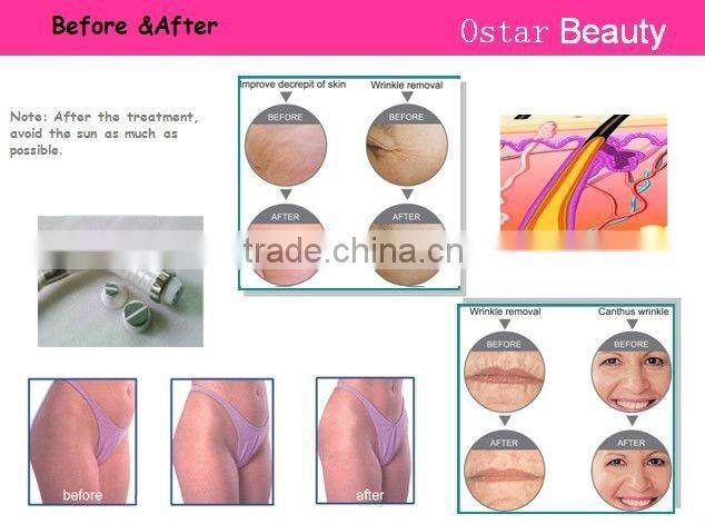 Cool 2013 RF machine wrinkle removal small business equipment for home use OB-R 01